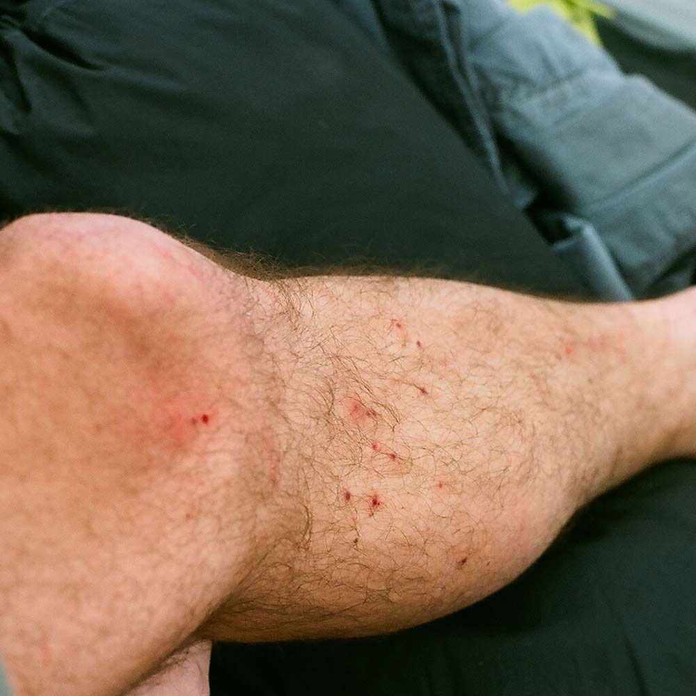black-fly-bites